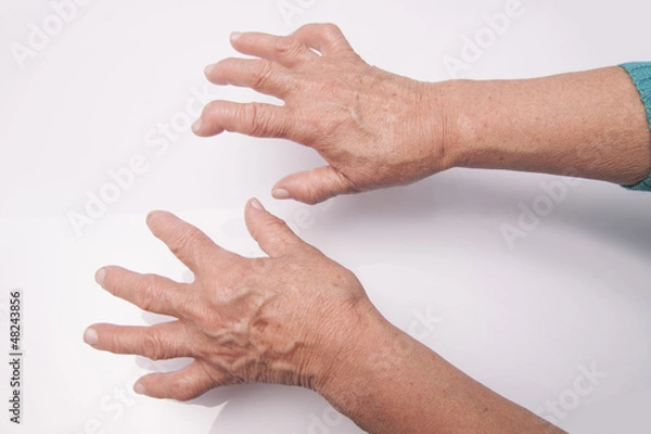 Fototapeta Hands With Rheumatoid Arthritis