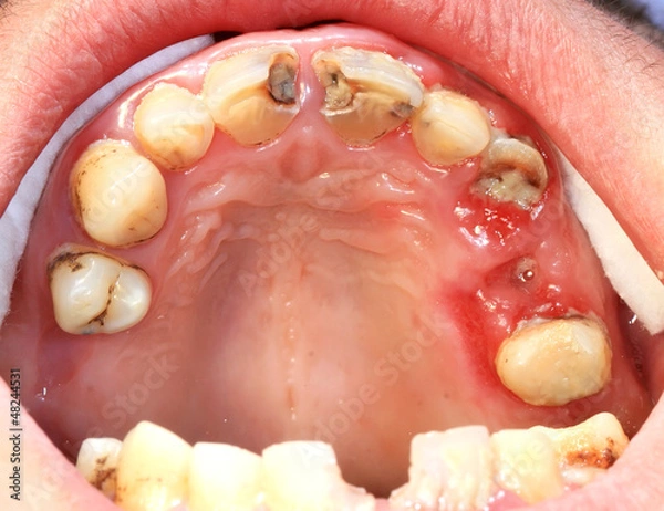 Fototapeta Unhealthy teeth