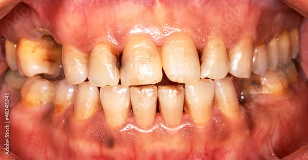 Fototapeta Discoloured teeth