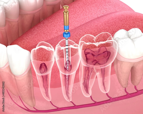 Fototapeta Endodontic root canal treatment process. Medically accurate tooth 3D illustration.