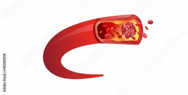 Obraz Blood clot thrombus medical poster