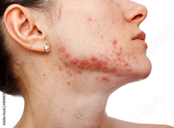 Obraz Młoda dziewczyna z problemem skóry