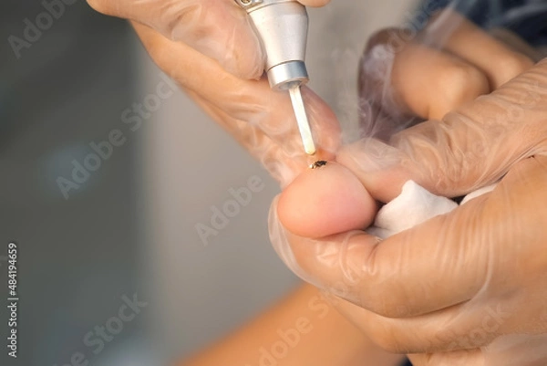 Fototapeta Surgeon removing wart on boy's thumb finger using laser in hospital, hands closeup. Remove papillomavirus verruca on finger hand. One day surgery concept. Sore and wound after operation.