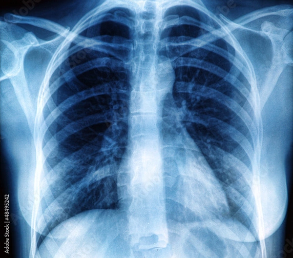 Obraz Chest X-ray image