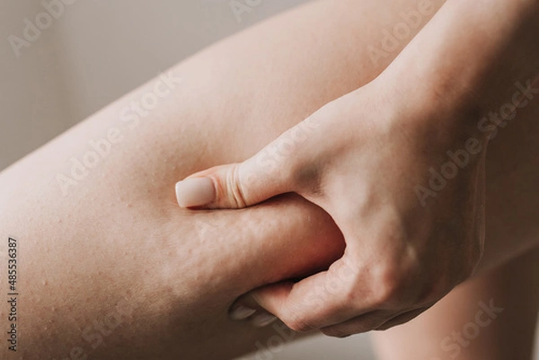 Obraz cellulite on the skin