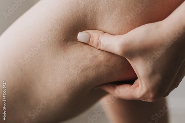 Obraz cellulite on the skin