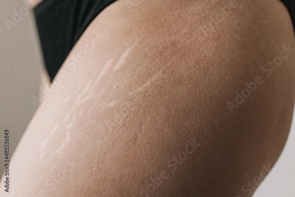 Fototapeta white stretch marks
