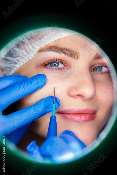 Fototapeta Macro close up detail of laser plasma pen removing facial wart on middle aged woman.