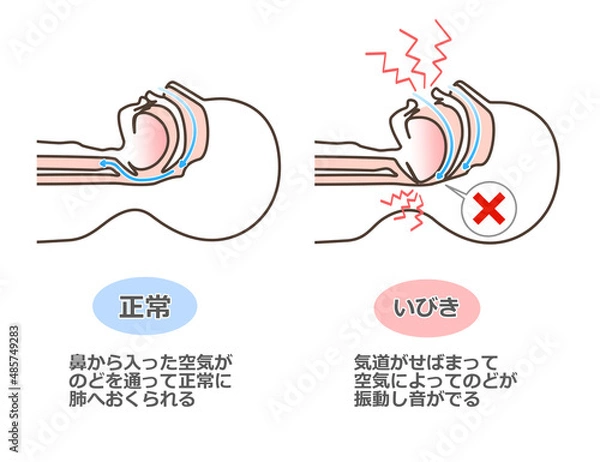 Obraz いびきの図解イラスト