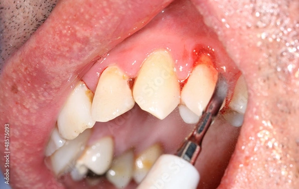 Obraz Gingivitis and atrophy