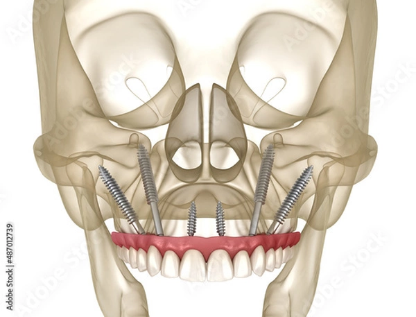 Fototapeta Maxillary prosthesis supported by zygomatic implants. Medically accurate 3D illustration of human teeth and dentures