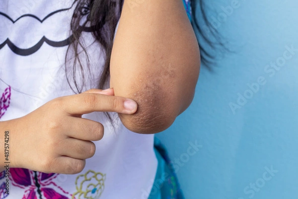 Fototapeta Finger of girl point to her elbow because dark patches on the skin and allergic rash known as acanthosis nigricans look like a darkened velvet.