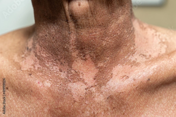 Fototapeta Male patient with tangue cancer who has actinic changes after radiotherapy
