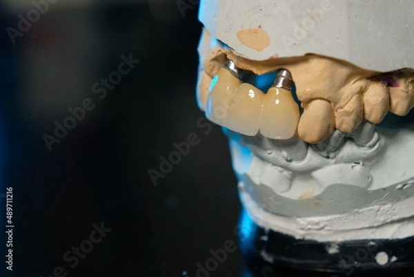 Obraz Dental implants and dentures in close-up Siemke on a black background