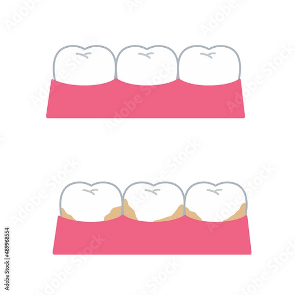 Obraz 健康的な歯と虫歯