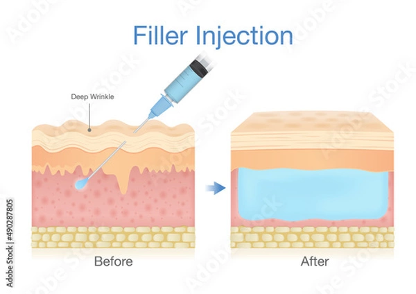 Fototapeta Filler injection into the skin layer by a needle for beauty surgery. Illustration about the result of skin treatment to reduce wrinkle.