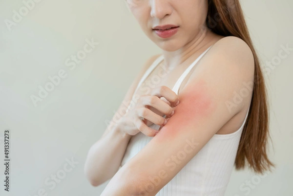 Fototapeta Dermatology, asian young woman, girl hand in her arm allergy, allergic reaction from atopic, insect bites, hand in scratching itchy, itch red spot or rash of skin. Beauty problem by medical treatment.