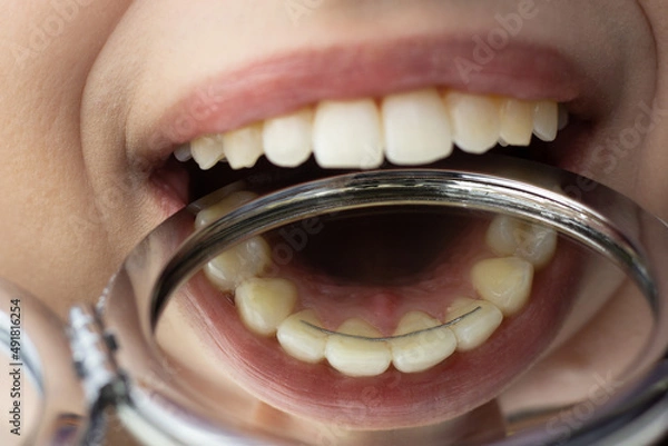 Fototapeta Closeup of a permanent bonded retainer on upper teeth.