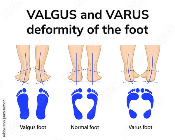 Fototapeta Illustration of the position of the feet in varus and valgus deformities. Depicted is a rear view of the feet and an imprint of the feet