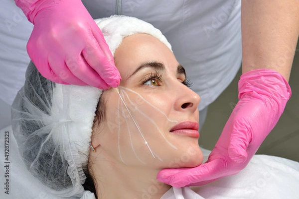 Fototapeta Thread lifting. Tightening of flabby skin in the jaw area with the help of cosmetic threads. Thread lifting. Tightening of flabby skin in the jaw area with the help of cosmetic threads.