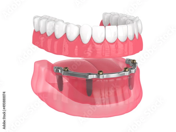 Obraz Bar retained removable overdenture installation supported by implants