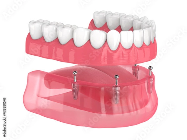 Obraz All-on-4 removable, implants supported, overdenture installation