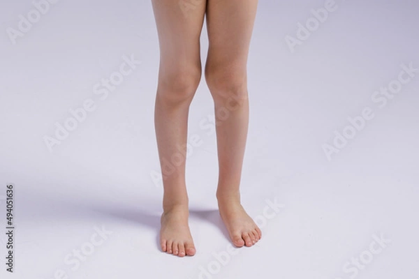Fototapeta the problem of knee deformity in a child. Legs of a girl close-up with a problem