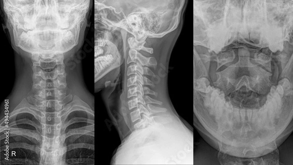 Fototapeta cervical spine of a patient in different projection..
