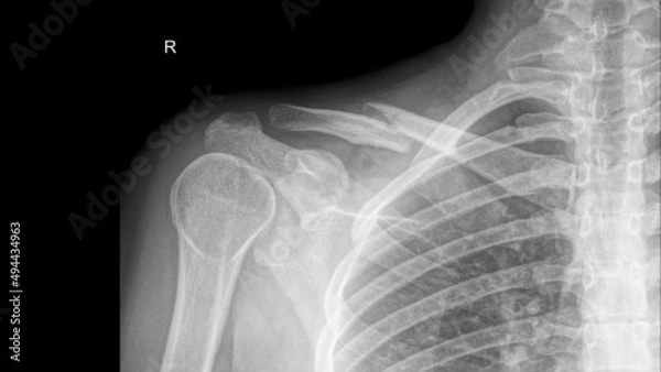 Fototapeta X-ray of a right  clavicle fracture