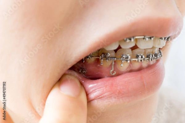 Obraz 日本人女性の歯科矯正イメージ