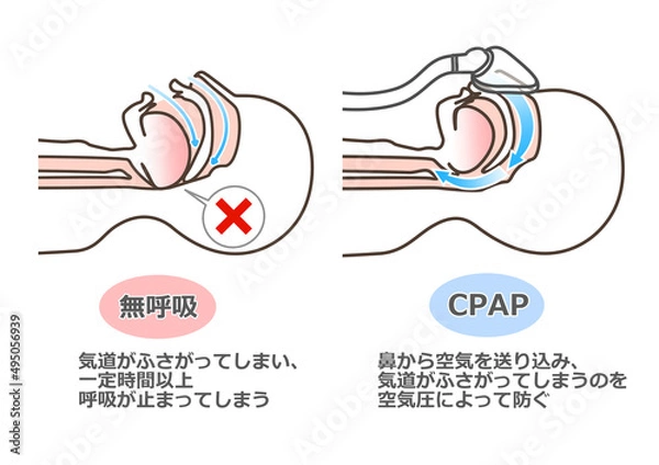 Fototapeta CPAPの図解