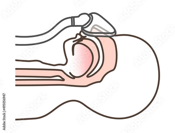 Fototapeta CPAPの図解