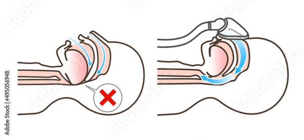 Fototapeta CPAPの図解