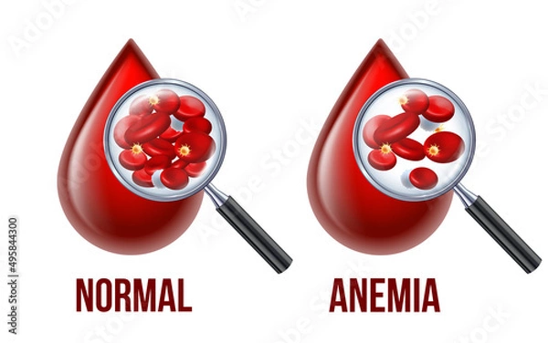 Fototapeta Iron deficiency anemia.The difference of Anemia amount of red blood cell and normal.