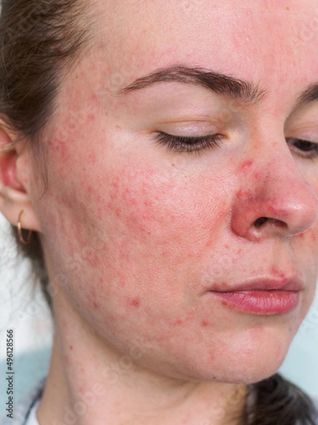 Obraz face of young woman with rosacea close-up