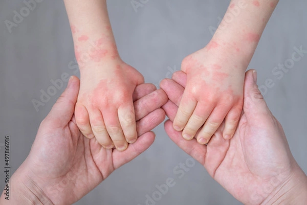Fototapeta close up mother holding kids hands with allergic rash or eczema. severe allergic reaction, atopic skin