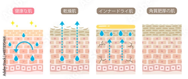 Obraz 健康な肌とダメージ肌の断面図 