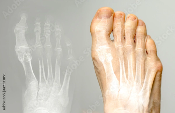 Fototapeta X-ray and the same foot. Hallux varus condition.
