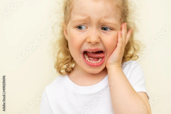 Fototapeta The child has a toothache. Children's caries in the initial stage.