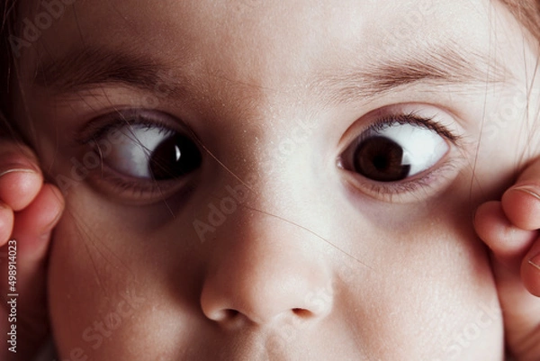 Fototapeta Eyes with squinted look and eyebrows on male face. Female eyes with strabismus. Hypertropia. Woman eyes suffering from strabismus - close up