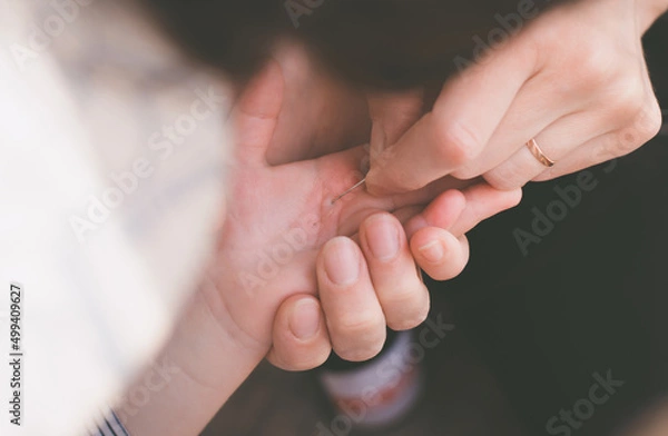 Fototapeta A woman takes a splinter out of a child's hand with a needle. A splinter in a child's hand