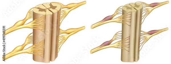 Fototapeta Ilustración de la médula espinal sana y con la enfermedad de Ataxia. La ataxia es la falta de control muscular o de coordinación de los movimientos voluntarios, como caminar o recoger objetos.