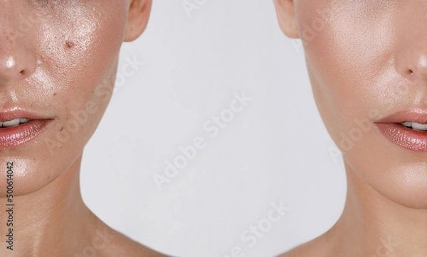 Fototapeta close-up girl with hyperhidrosis on her face and excessive oily sheen, with enlarged pores and nevus. before and after treatment with botulinum toxin injections
