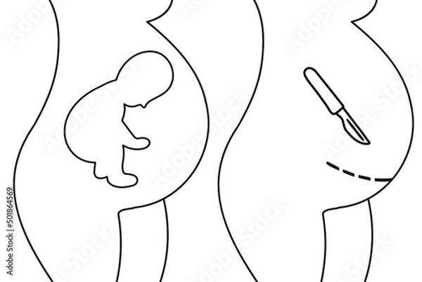 Obraz Breech presentation. Fetal baby positions in the uterus during pregnancy. Cesarean section flat icon. Scalpel near belly. Surgical operation for childbirth.