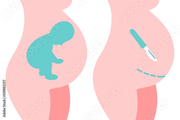 Obraz Breech presentation. Fetal baby positions in the uterus during pregnancy. Cesarean section flat icon. Scalpel near belly. Surgical operation for childbirth.