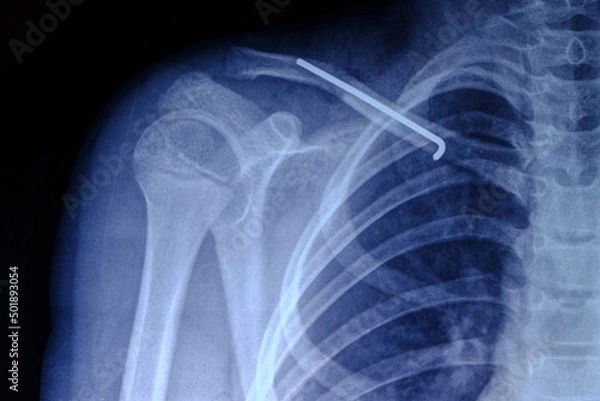 Fototapeta X ray image person with broken collarbone and spoke installed in it after surgery.