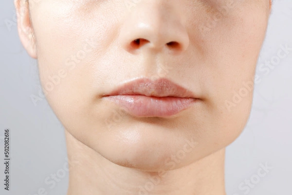 Fototapeta Closeup of down part of females face of suffering from strong tooth pain. Consept of the cheek swelling, teeth problem: gumboil, flux, dental health and care. 1 day after surgery.