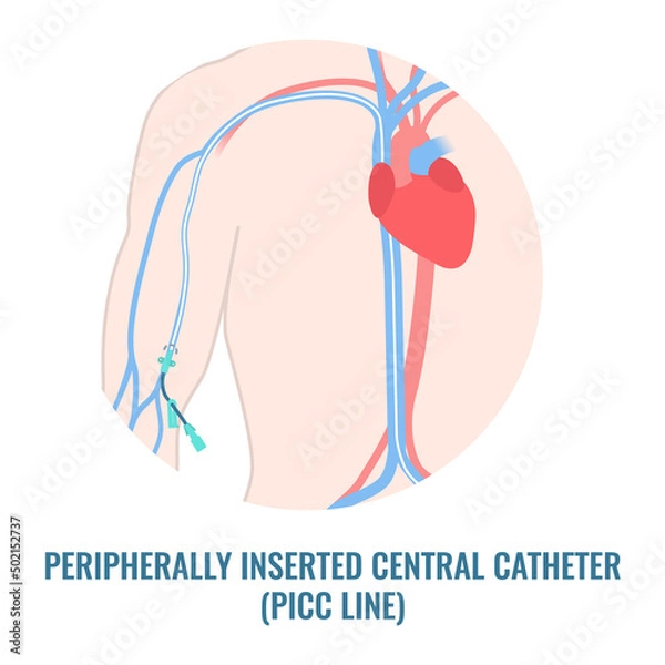 Fototapeta Peripherally inserted central catheter placed in the upper arm vein. Patient with PICC tube for medication and nutrition fluid delivery. Health care concept. Medical vector illustration.