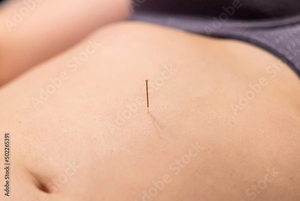 Fototapeta A portrait of a thin acupuncture needle between navel and sternum, put in place by an acupuncturist. This alternative medicine treatment is used for stimulation, relaxing, healing and stress relief.