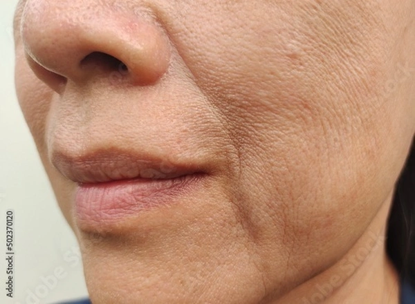 Fototapeta close up portrait flabbiness adipose beside the mouth, problem wrinkles and sagging skin on the face of the woman, concept health care.